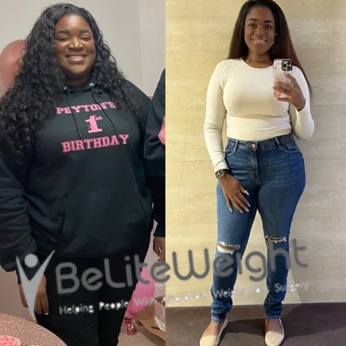 Weight Loss Surgery Before And After